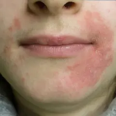 Rodnad och fjällande hud runt munnen, möjligtvis perioral dermatit kopplad till klimakteriet.