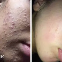Före- och efterbilder visar en ansiktshud med många inflammerade finnar som sedan blivit klarare.