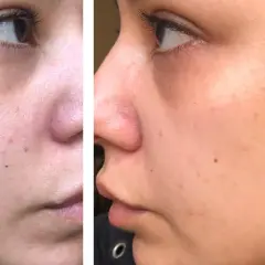 Bilden visar en persons ansikte med finnar och ojämn hud. Det verkar som att dermapen fungerar inte för att förbättra hudens utseende.