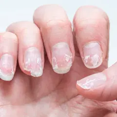 Nära bild på en hand med torra, spruckna nagelband och flagande naglar.