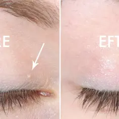 Före och efter-bild som visar hur man kan ta bort milier hemma. En liten vit prick under ögat är borta.