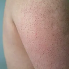 Närbild på en arm med keratosis pilaris, små röda prickar som kan drabba barn och vuxna.