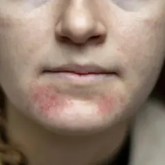 När huden känns torr runt munnen kan det se ut så här. Röda, irriterade fläckar syns tydligt.