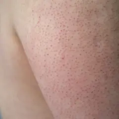 Närbild på hud med små röda prickar, typiskt för keratosis pilaris på armen.