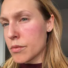 Kvinna med rodnad på kinderna, möjligen niacinamide biverkningar. Håret är blont och hon bär en örhänge.