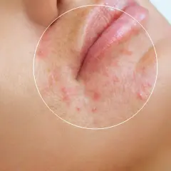 Närbild på munnen med rodnad och små utslag, tecken på perioral dermatit.