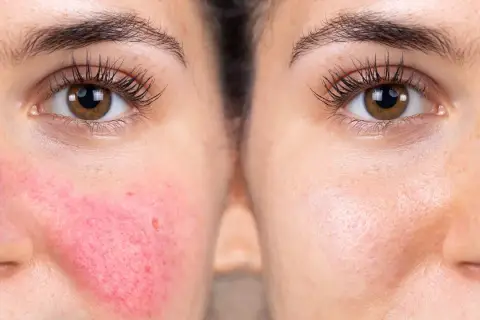 Före- och efterbilder visar hudvård för rosacea. Vänster sida visar rodnad och synliga blodkärl, höger sida visar en lugnare hud.