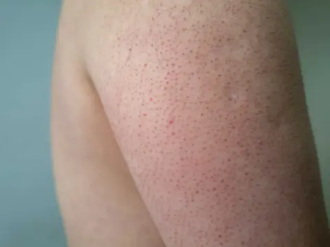 Keratosis pilaris barn - Lugna knottrig hud & när söka vård
