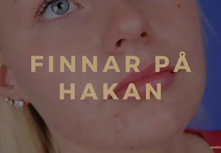 När finnar på hakan dyker upp kan det kännas jobbigt. Bilden visar en närbild på en persons haka med synliga finnar.