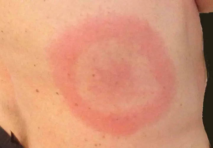 Rött, ringformat utslag på huden, möjligtvis ett stress utslag.
