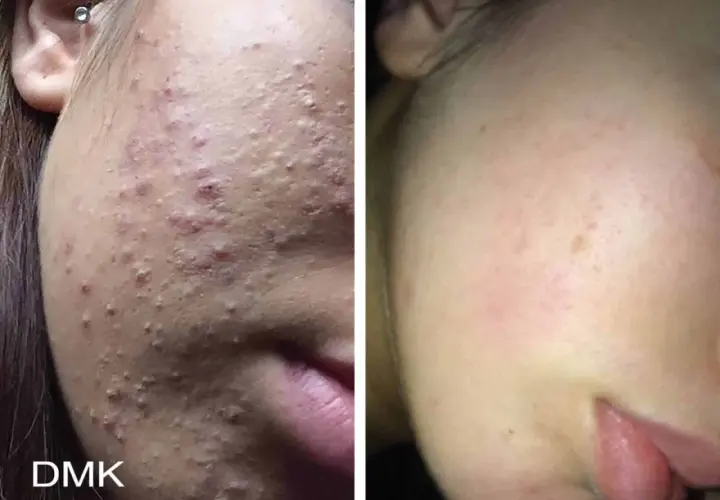 Före- och efterbilder visar en ansiktshud med många inflammerade finnar som sedan blivit klarare.