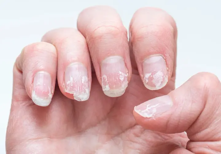 Nära bild på en hand med torra, spruckna nagelband och flagande naglar.