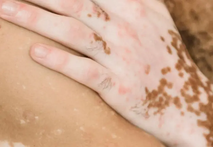 Närbild på en hand och arm med vitiligo, där vita prickar på huden skapar ett unikt mönster.