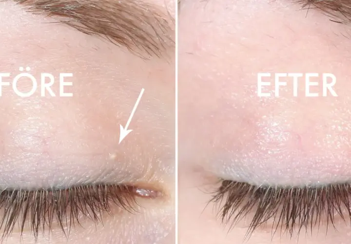 Före och efter-bild som visar hur man kan ta bort milier hemma. En liten vit prick under ögat är borta.