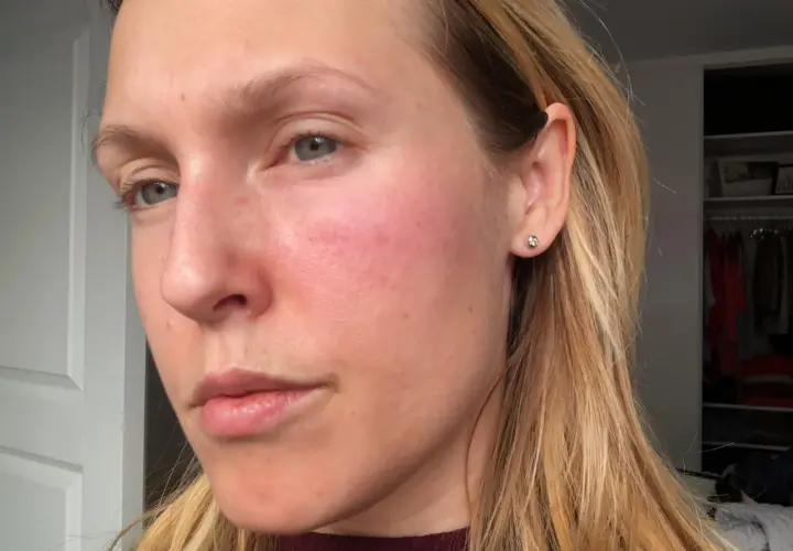 Kvinna med rodnad på kinderna, möjligen niacinamide biverkningar. Håret är blont och hon bär en örhänge.