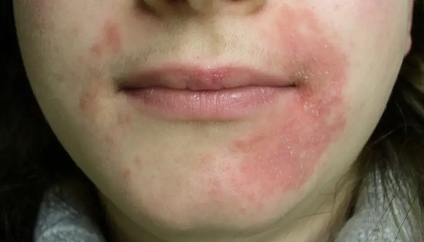 Rodnad och fjällande hud runt munnen, möjligtvis perioral dermatit kopplad till klimakteriet.