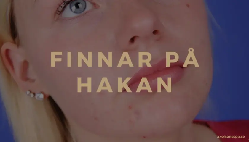 När finnar på hakan dyker upp kan det kännas jobbigt. Bilden visar en närbild på en persons haka med synliga finnar.