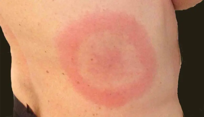 Rött, ringformat utslag på huden, möjligtvis ett stress utslag.