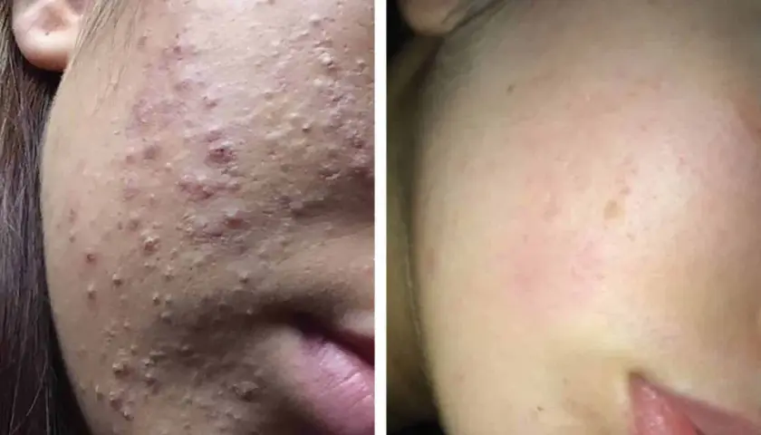 Före- och efterbilder visar en ansiktshud med många inflammerade finnar som sedan blivit klarare.