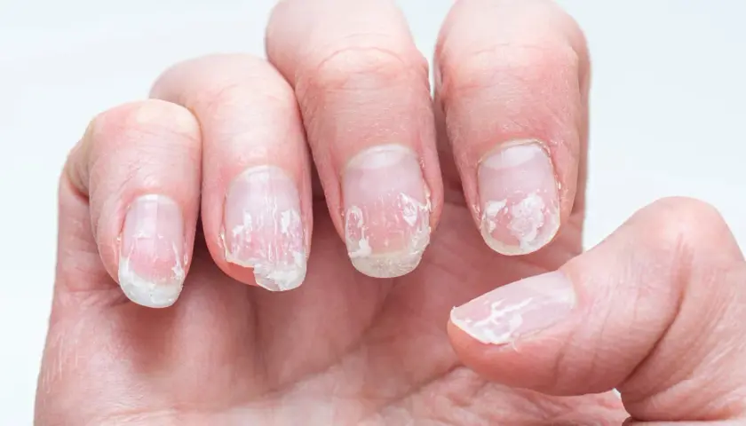 Nära bild på en hand med torra, spruckna nagelband och flagande naglar.