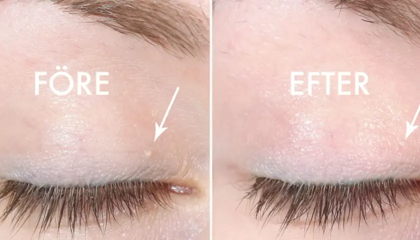 Före och efter-bild som visar hur man kan ta bort milier hemma. En liten vit prick under ögat är borta.