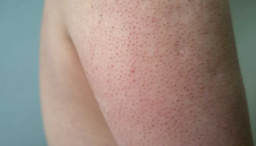 Närbild på en arm med keratosis pilaris, små röda prickar som kan drabba barn och vuxna.