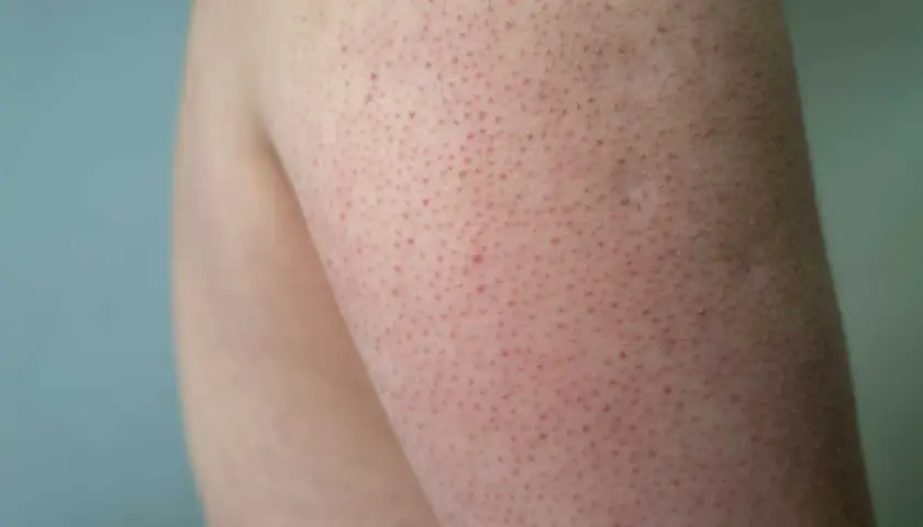 Närbild på hud med små röda prickar, typiskt för keratosis pilaris på armen.
