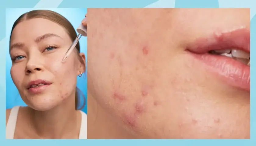 Närbild på en kvinna som applicerar serum på huden, med fokus på finnar på halsen och kinden.