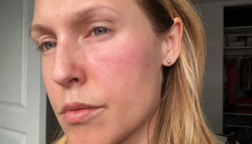 Kvinna med rodnad på kinderna, möjligen niacinamide biverkningar. Håret är blont och hon bär en örhänge.