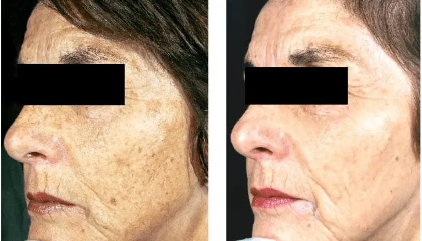 Före och efter-bilder visar en kvinnas ansikte med solskadad hud, pigmentfläckar och rynkor. Efter-bilden visar en förbättring.