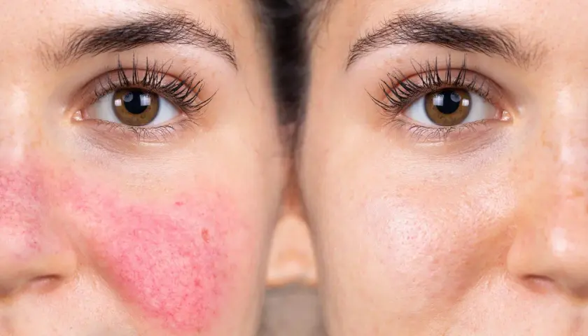 Före- och efterbilder visar hudvård för rosacea. Vänster sida visar rodnad och synliga blodkärl, höger sida visar en lugnare hud.