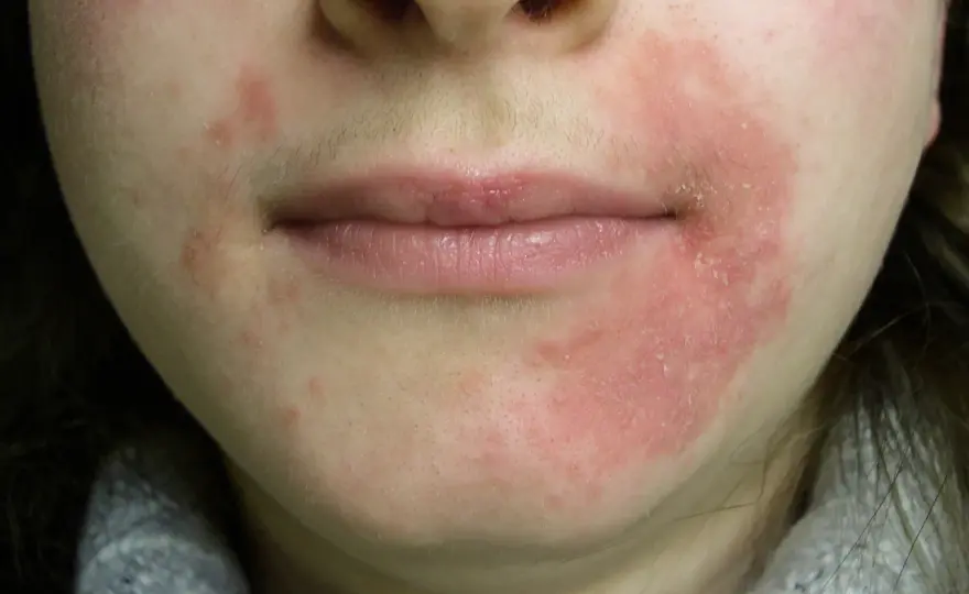 Perioral dermatit i klimakteriet - Lugna huden igen