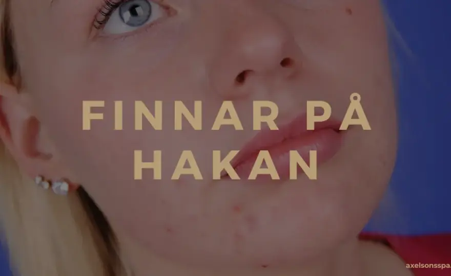 Finnar på hakan - Därför får du dem och så blir du av med dem