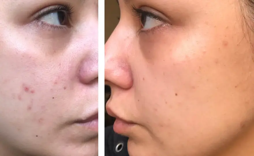 Dermapen fungerar inte? – Därför uteblir resultatet & vad du gör