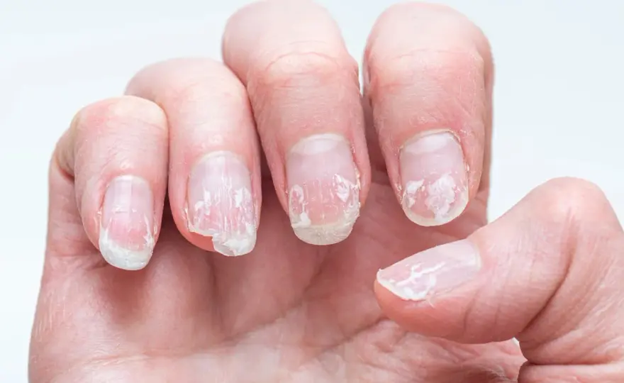 Spruckna nagelband - Få mjuka händer med rätt vård!