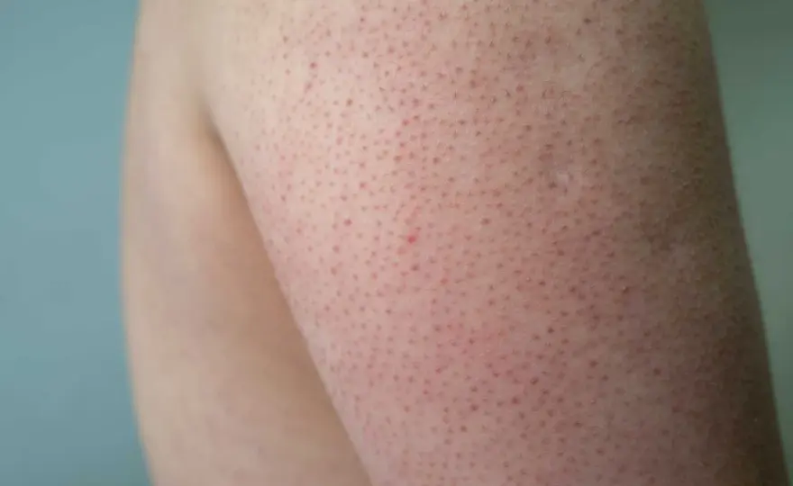 Keratosis pilaris barn - Lugna knottrig hud & när söka vård