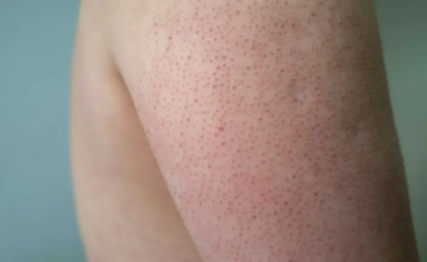 Knottrig hud – Keratosis pilaris: Lugna huden effektivt