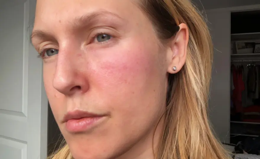 Niacinamid biverkningar - När huden reagerar & vad du gör