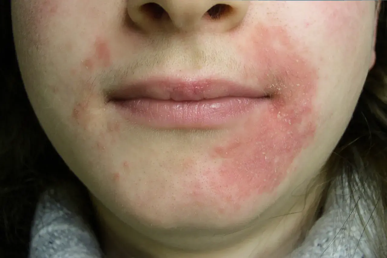 Rodnad och fjällande hud runt munnen, möjligtvis perioral dermatit kopplad till klimakteriet.