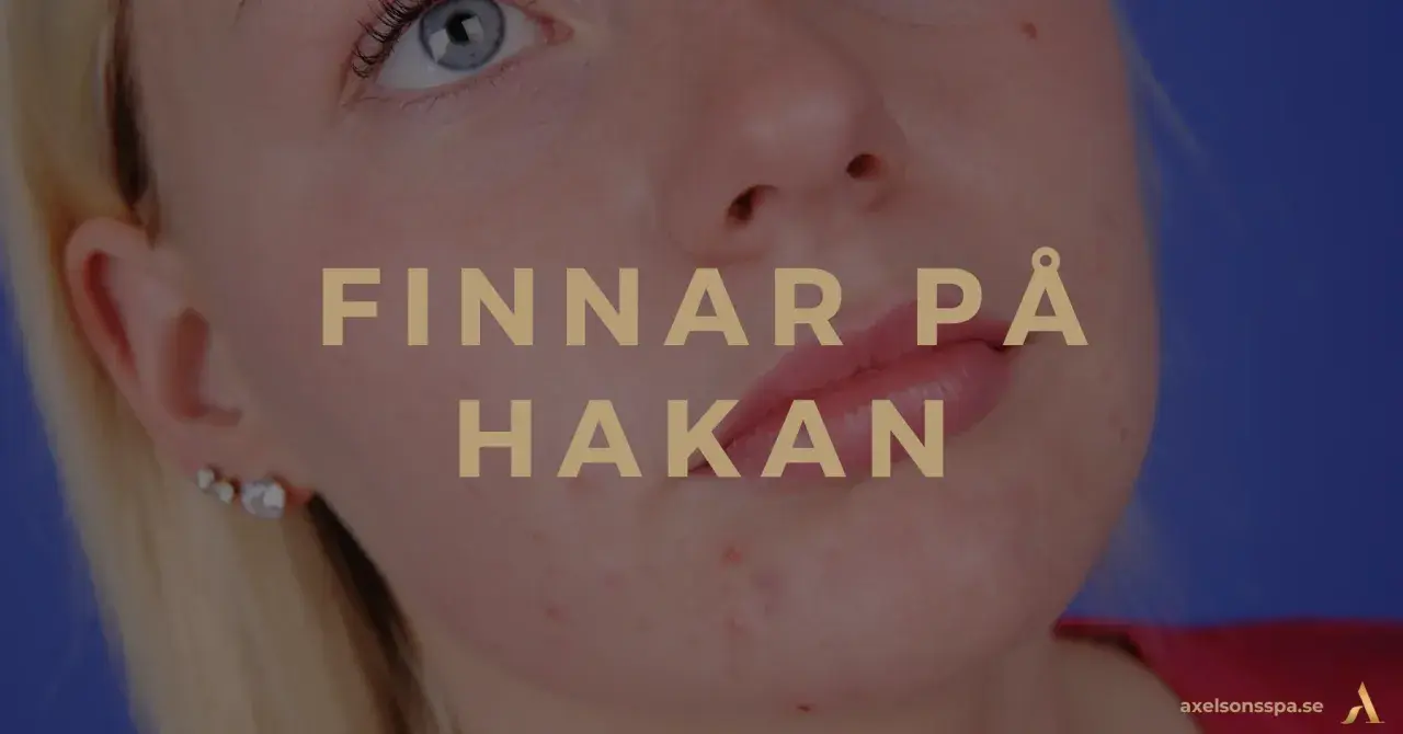 När finnar på hakan dyker upp kan det kännas jobbigt. Bilden visar en närbild på en persons haka med synliga finnar.