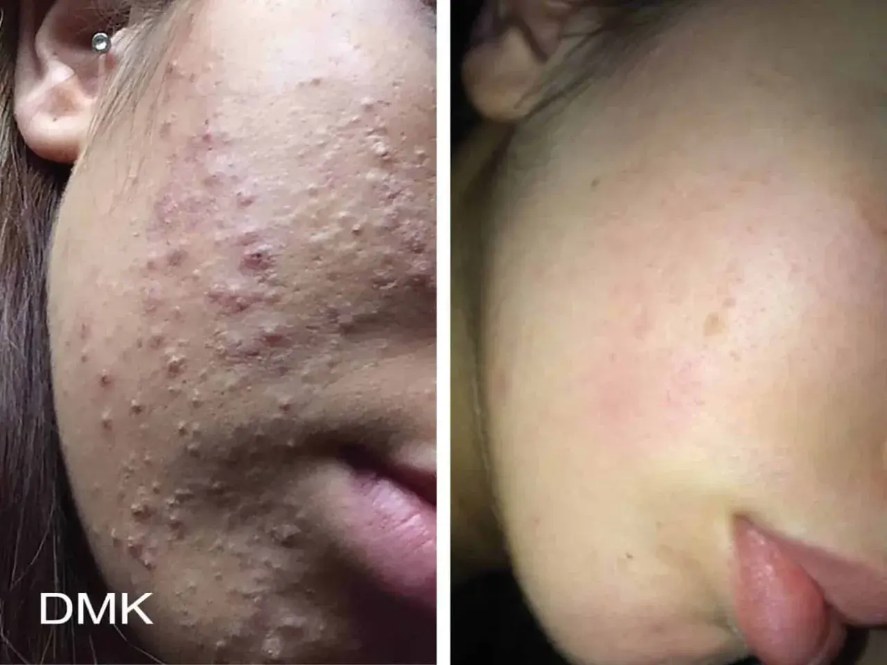 Före- och efterbilder visar en ansiktshud med många inflammerade finnar som sedan blivit klarare.