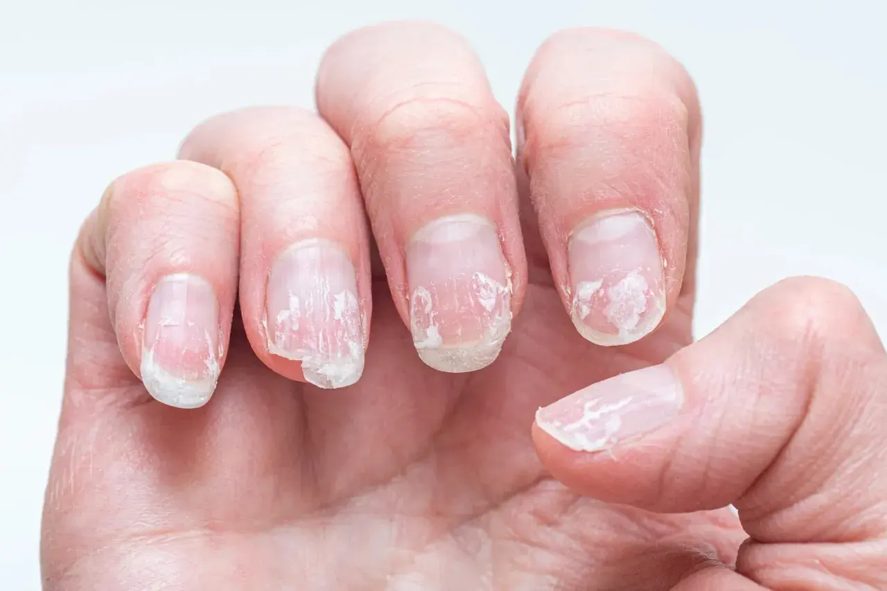 Nära bild på en hand med torra, spruckna nagelband och flagande naglar.