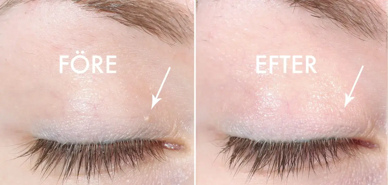 Före och efter-bild som visar hur man kan ta bort milier hemma. En liten vit prick under ögat är borta.