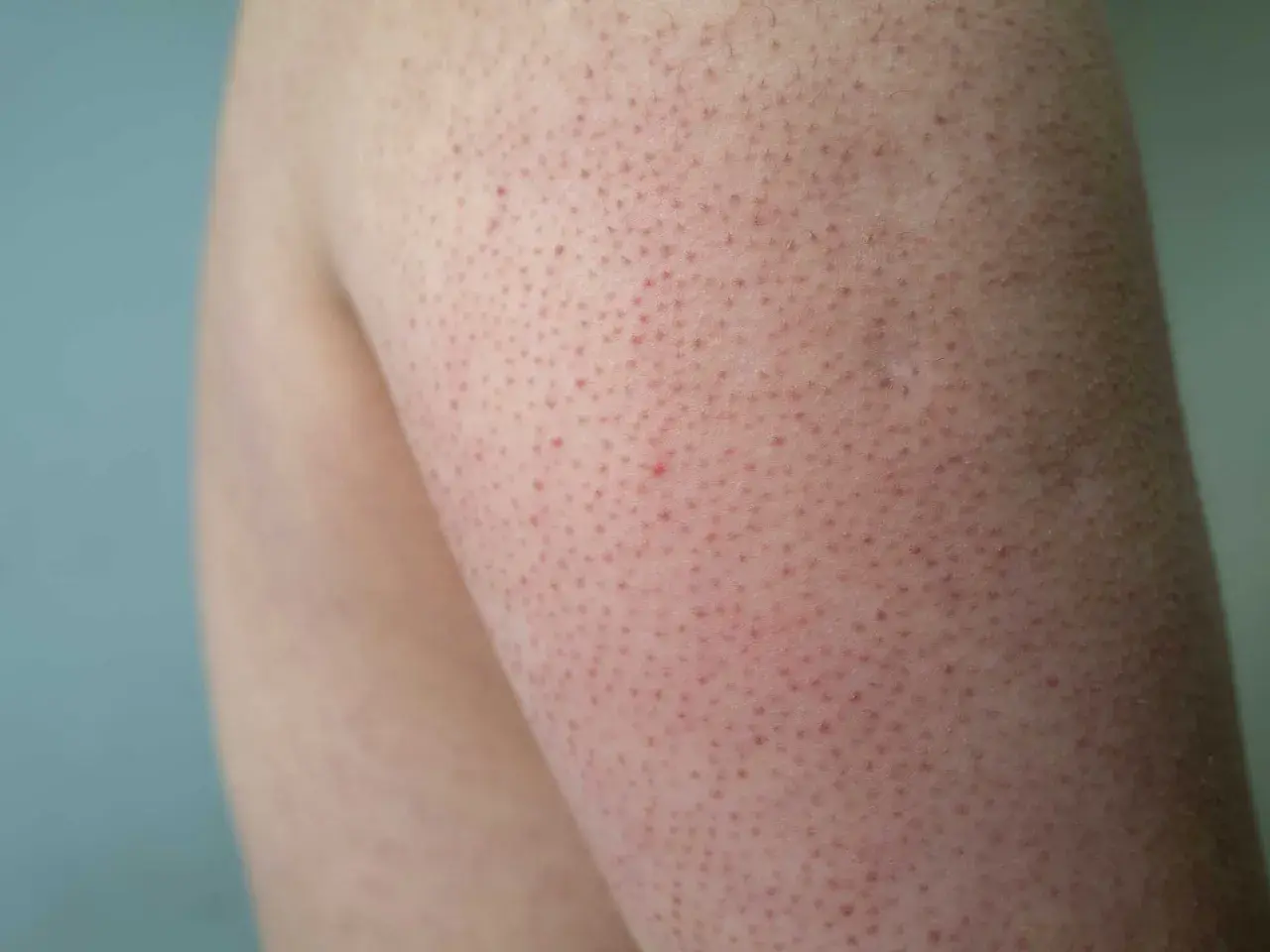 Närbild på en arm med keratosis pilaris, små röda prickar som kan drabba barn och vuxna.