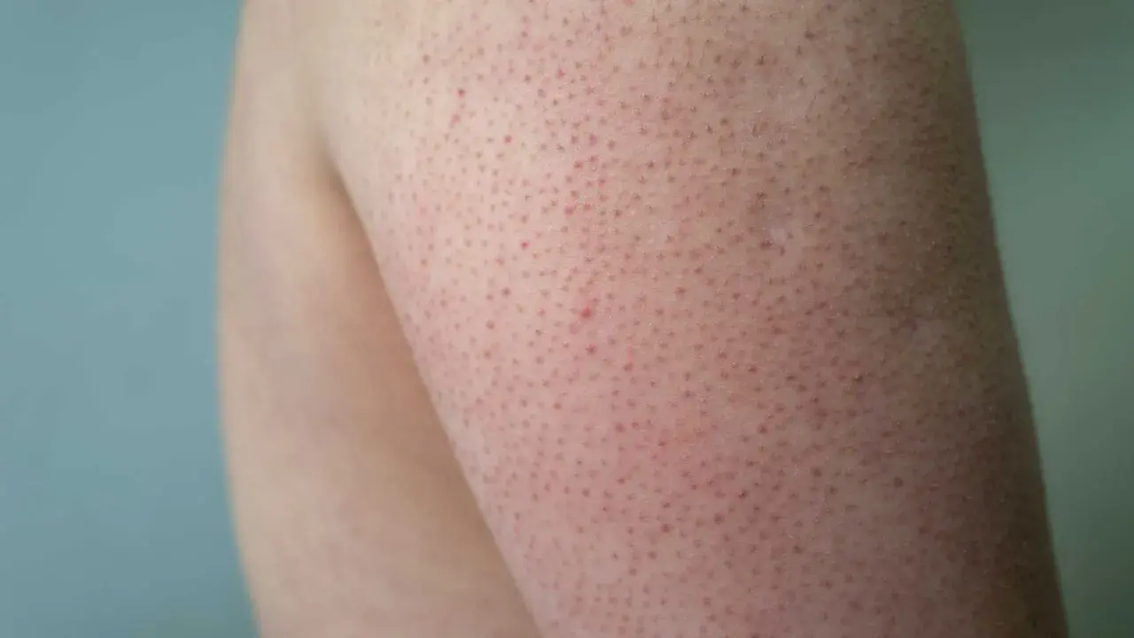 Närbild på hud med små röda prickar, typiskt för keratosis pilaris på armen.