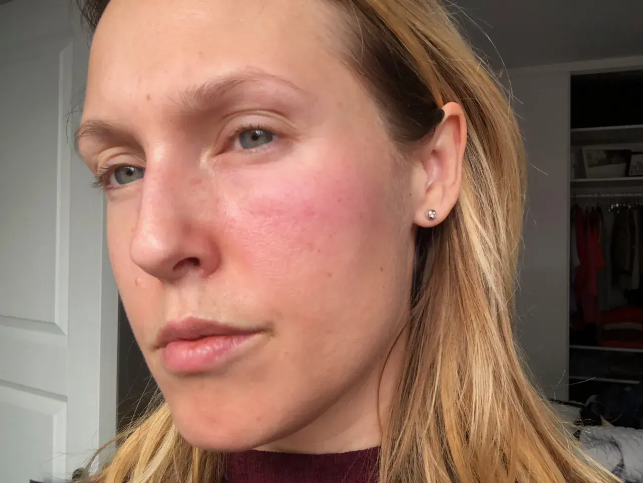Kvinna med rodnad på kinderna, möjligen niacinamide biverkningar. Håret är blont och hon bär en örhänge.