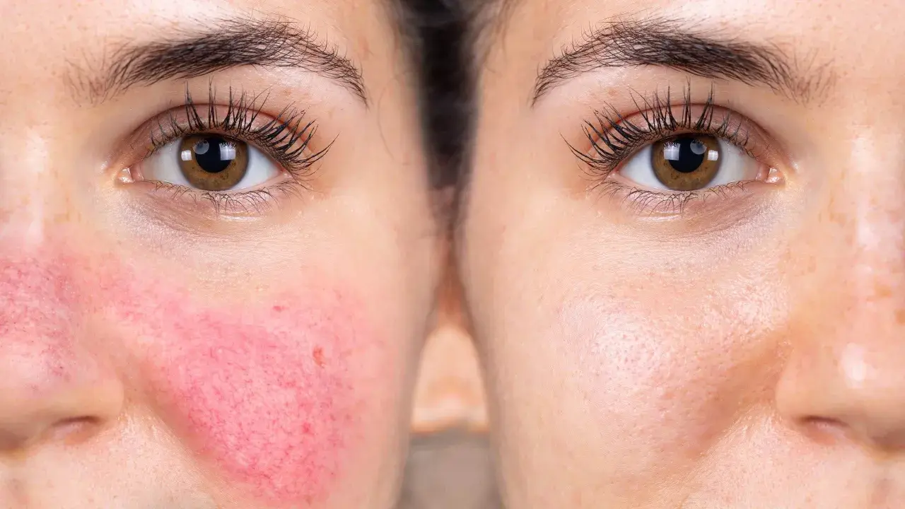 Före- och efterbilder visar hudvård för rosacea. Vänster sida visar rodnad och synliga blodkärl, höger sida visar en lugnare hud.