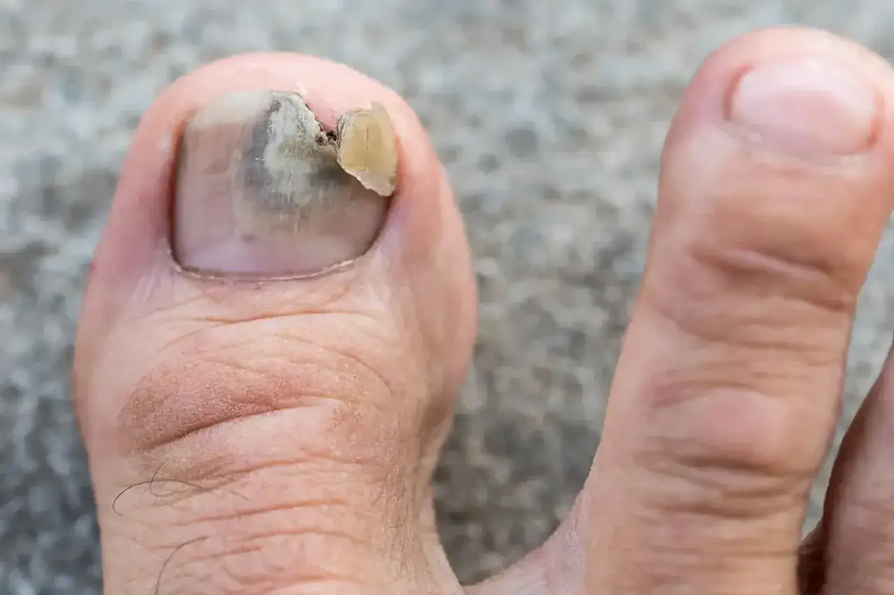 N&auml;ra bild p&aring; en t&aring; med ett skadat, missf&auml;rgat nagel. Nageln har en m&ouml;rkare ton och en bit har flagnat av, vilket ger intryck av gula naglar.