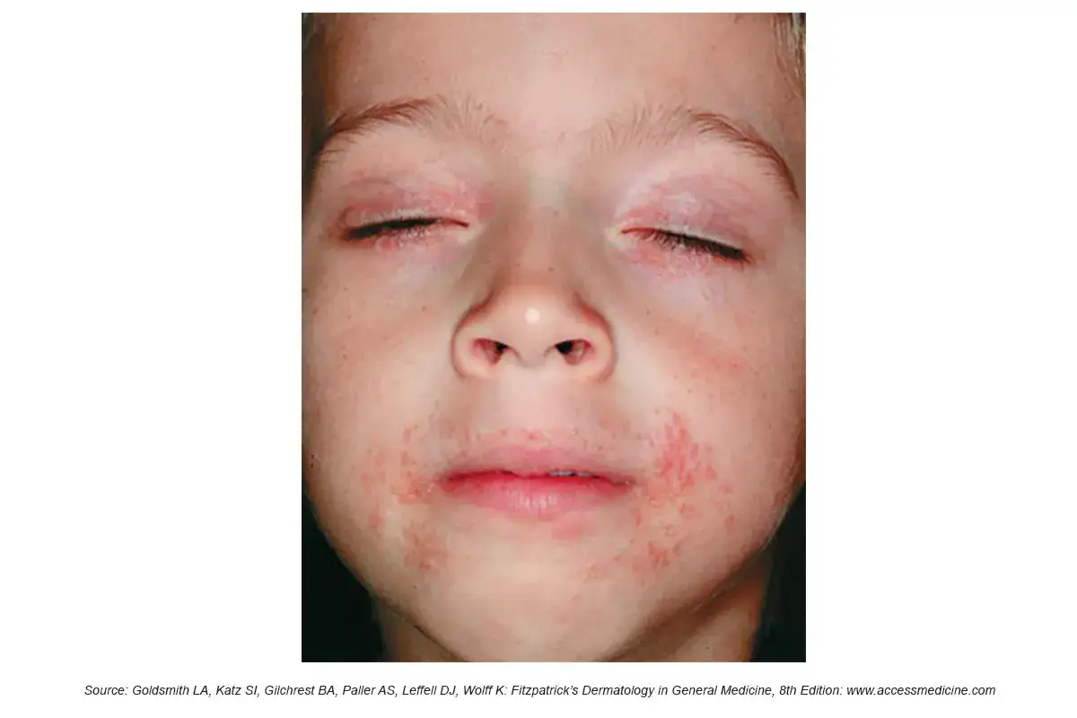 Barn med rodnad och utslag runt munnen, möjligen relaterat till perioral dermatit orsakad av stress.