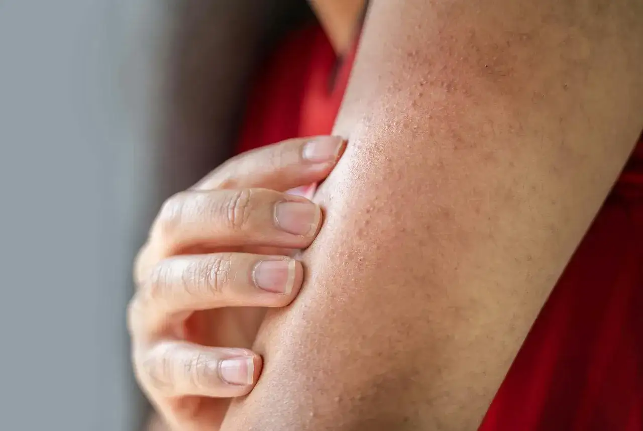 N&auml;ra bild p&aring; en arm med sm&aring; knottror som tyder p&aring; keratosis pilaris. En hand r&ouml;r vid huden.